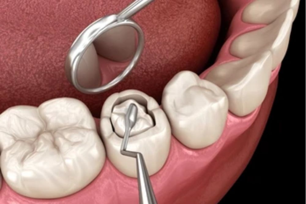 dental fillings in Fairview