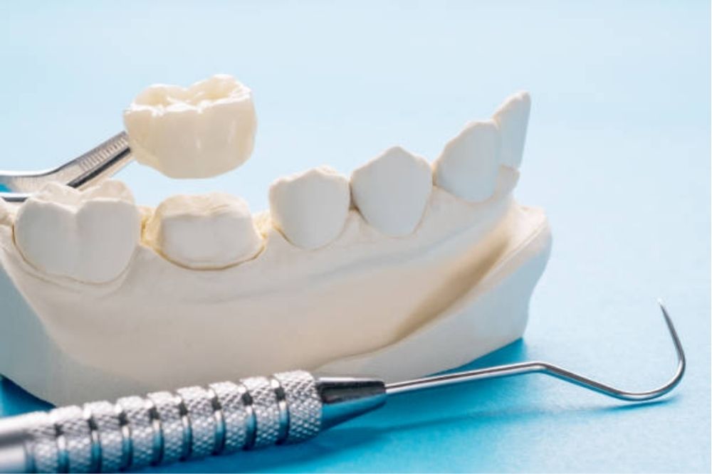 dental crowns in Fairview